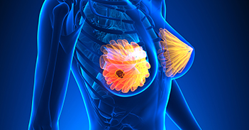 乳腺肿瘤 上海乳腺癌筛查