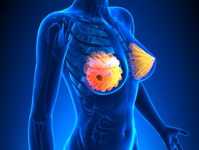 乳腺癌早期检查方法